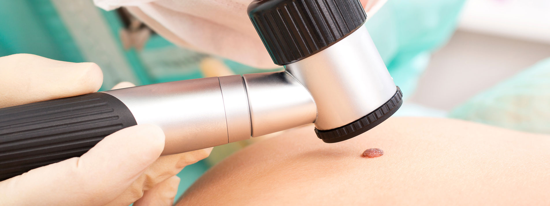 Dermatoskopie in der Dermatologie Praxis Hautarzt Dr. Mader & Kollegen in Goch