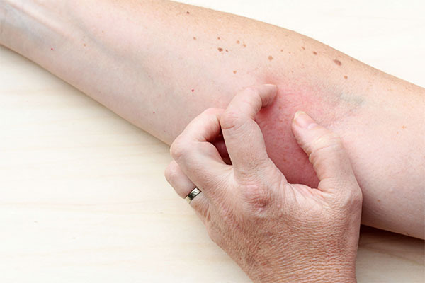 Neurodermitis (atopisches Ekzem) · MVZ MADERMA GmbH Dr. Mader & Kollegen · Hautarzt Praxis Goch ·