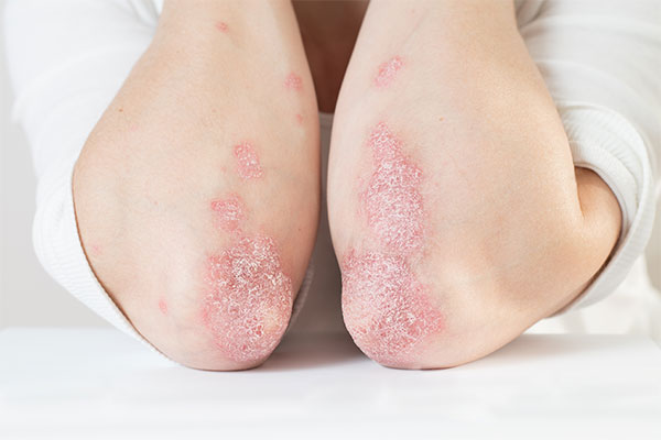 Schuppenflechte (Psoriasis) · MVZ MADERMA GmbH Dr. Mader & Kollegen · Hautarzt Praxis Goch ·